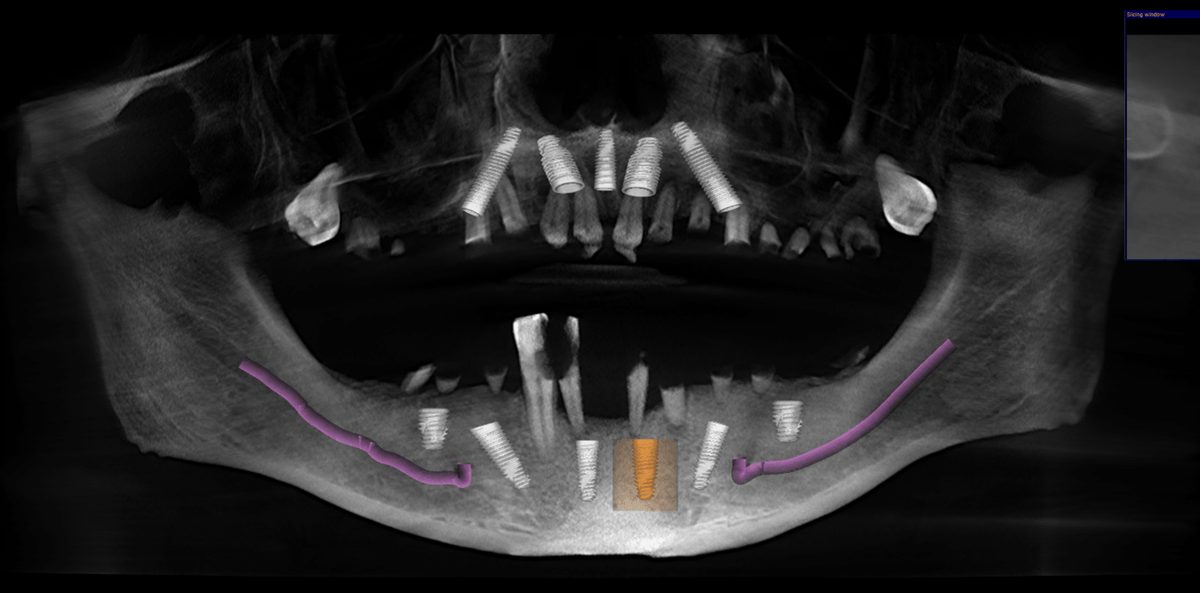 Digital dental X-ray