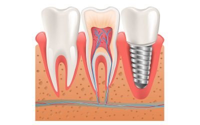 Dental Tips on Dental Implants: Should You Shop Around?