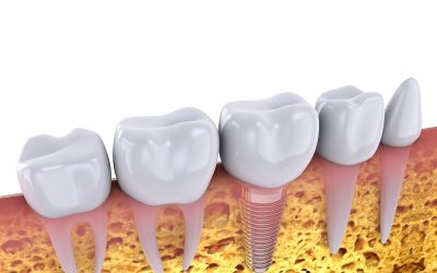 I Damaged My Dental Implant – How Serious is it, And What Do I Do?