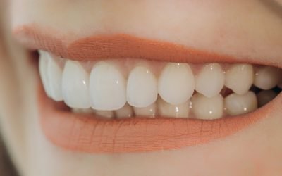 Dental Tips: Will I Ever Get Cavities with Dental Veneers?