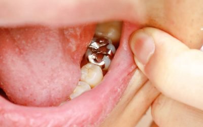 How to Select the Best Type of Dental Fillings in Hoppers Crossing