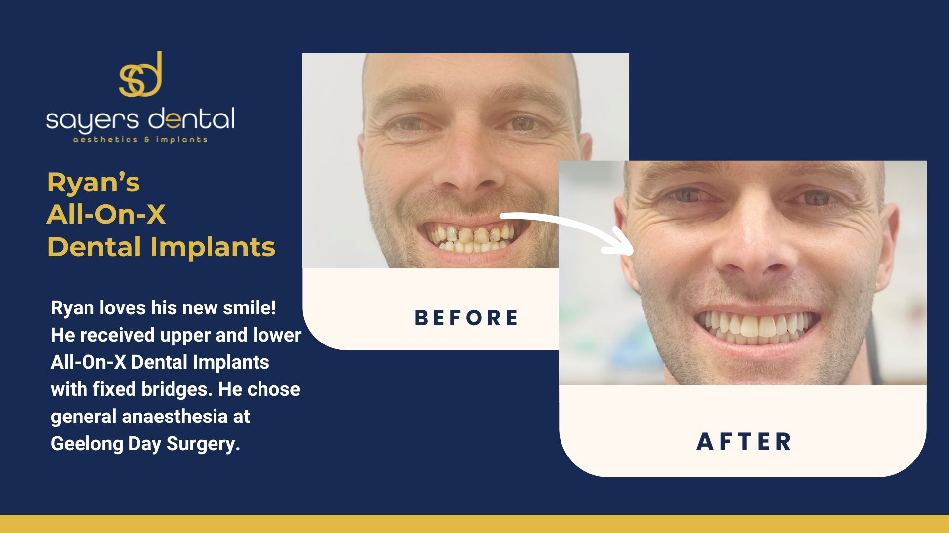 Ryan All-On-X Dental Implants