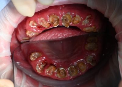 Full Arch Patient Before