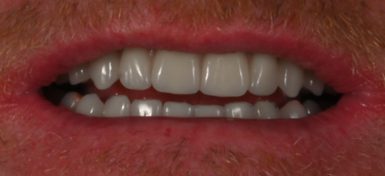 Full Arch All-On-X Dental Implants - After