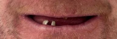 Full Arch All-On-X Dental Implants - Before